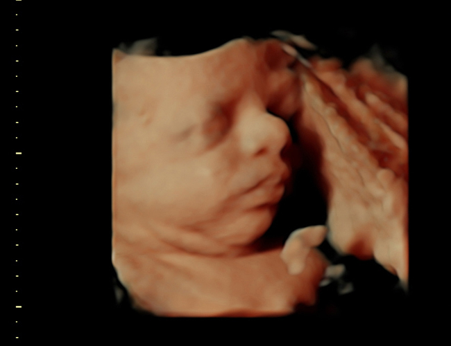 3D ultrasound image at 31 weeks